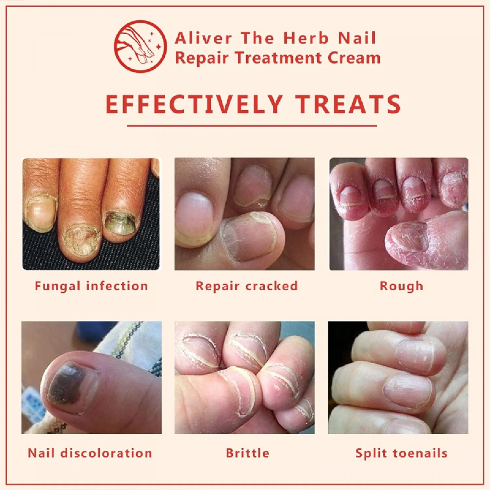 Aliver Herb Premium Fungal Nail Treatment Powerful Anti Fungal Nail Infection Solution Cream