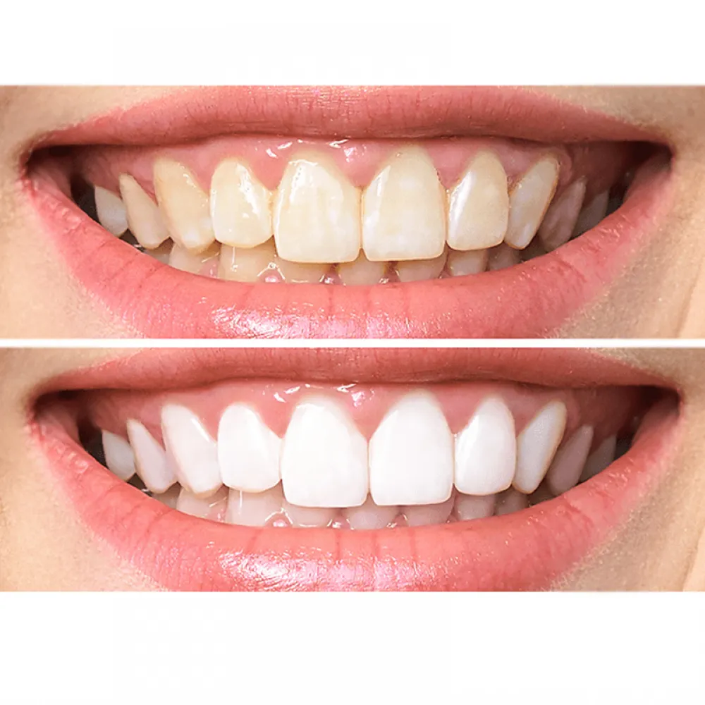 Stella White Whitening Teeth Strips - 6 Stripes